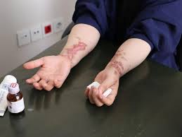 مجازات اسیدپاشی